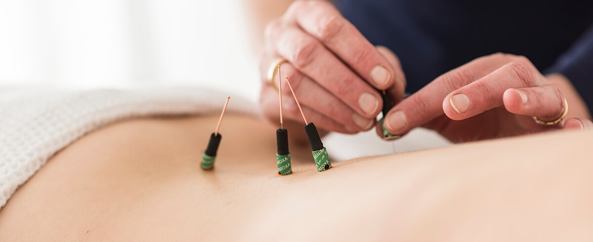 Moxibustion Behandlung Würzburg